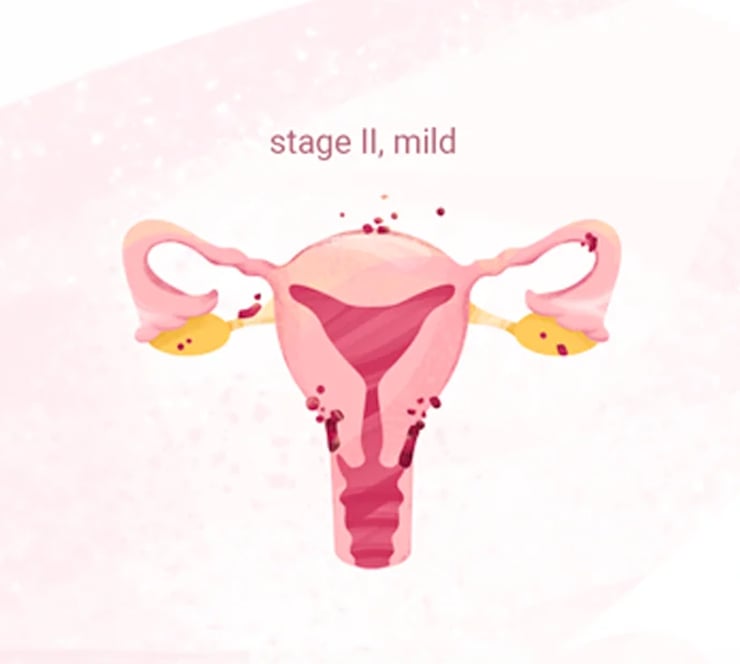 stage2-endometriosis-internalsymptoms