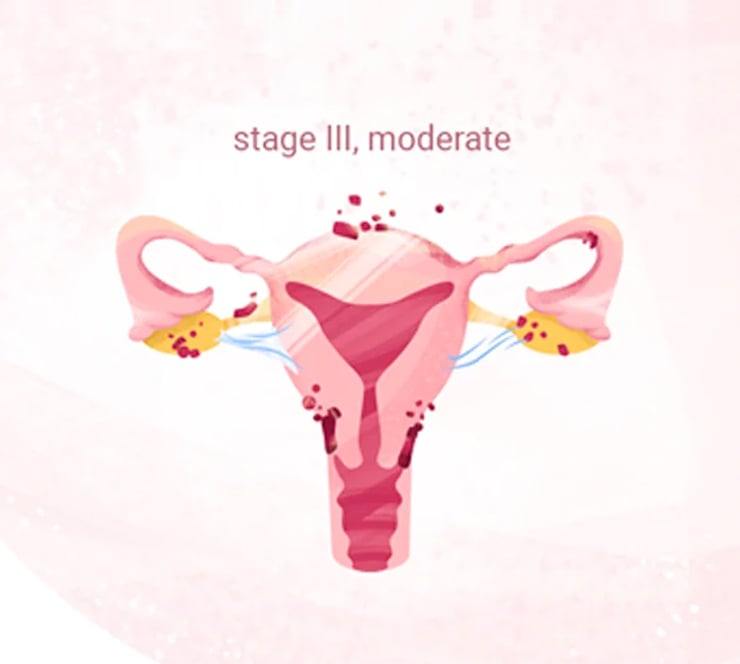 stage3-endometriosis-internalsymptoms