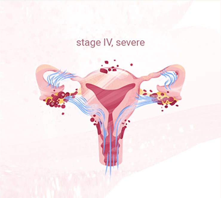 stage4-endometriosis-internalsymptoms